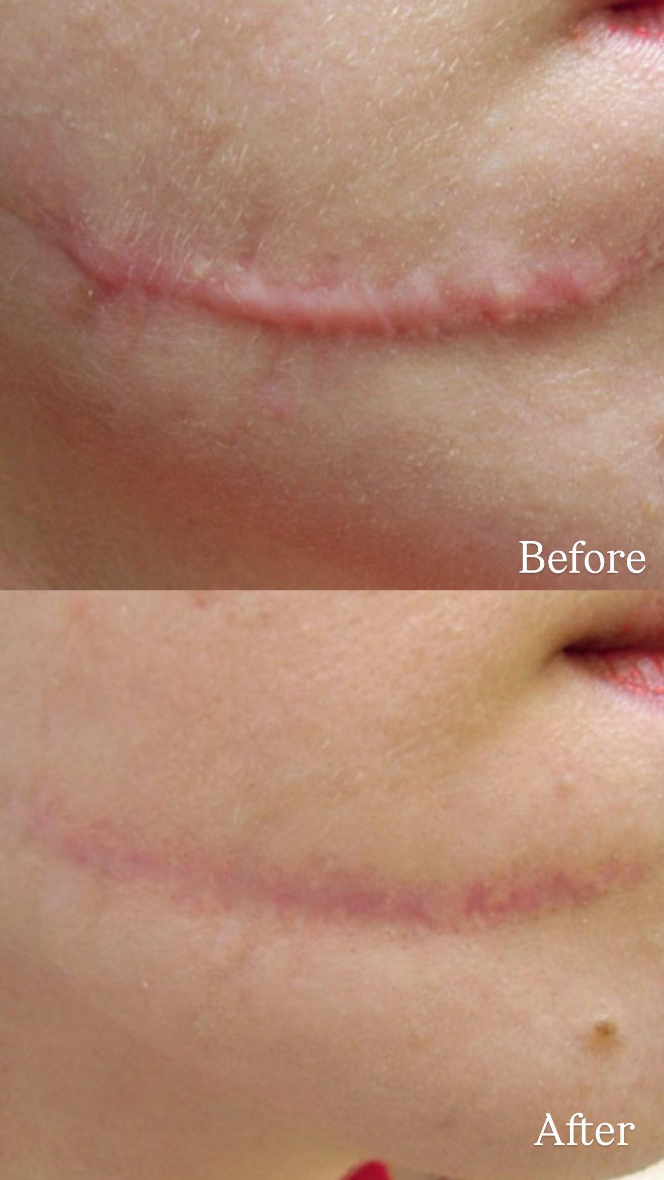 hypertrophic scar of the chin region before