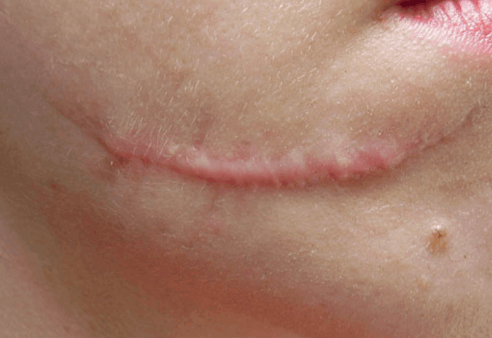 hypertrophic scar of the chin region before