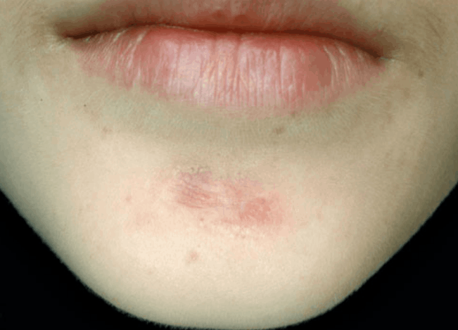 keloid of a puncture wound after combined treatment