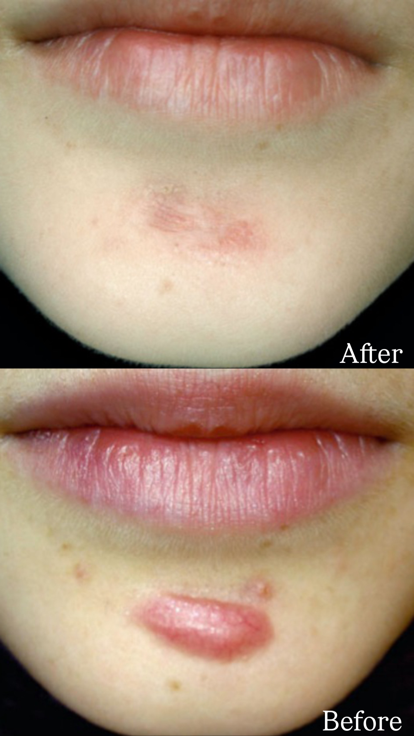 Keloid of a Puncture Wound before and after combined treatments