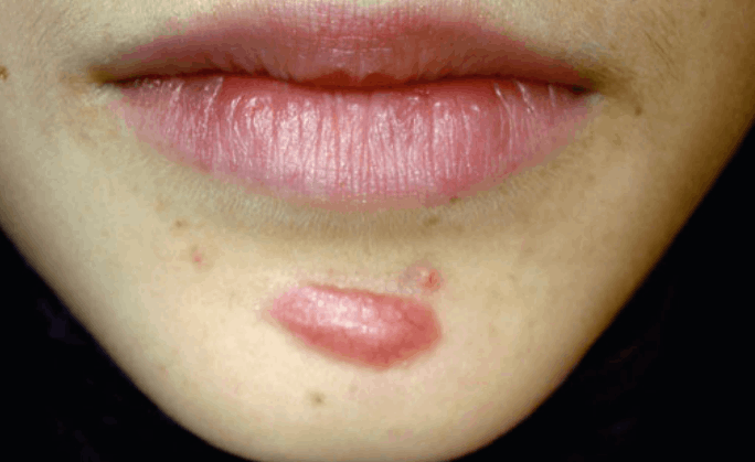 keloid of a puncture wound before combined treatment