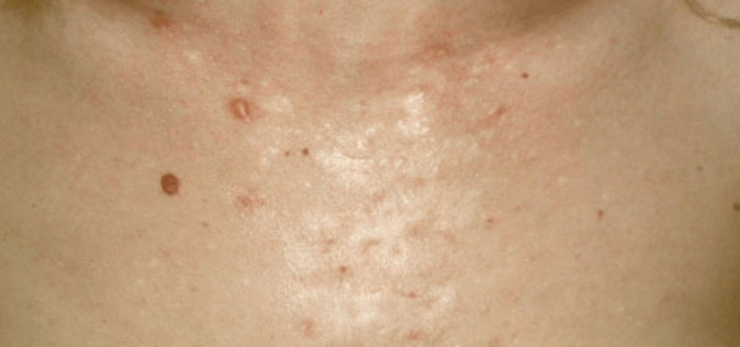 keloid scar after surgical excision and combined treatment