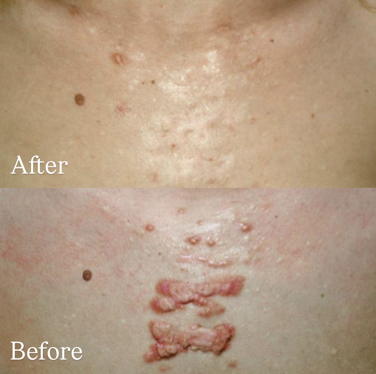 Chest Region Postsurgery Keloid Scar before and after combined treatments