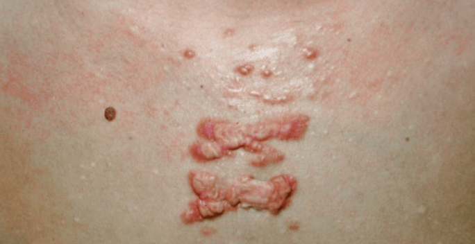 keloid scar before surgical excision
