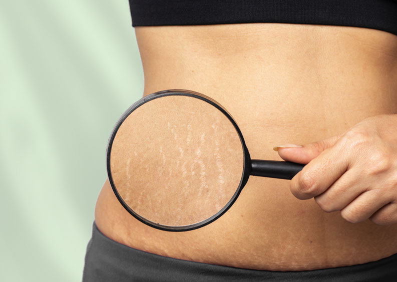 Stretch mark removal