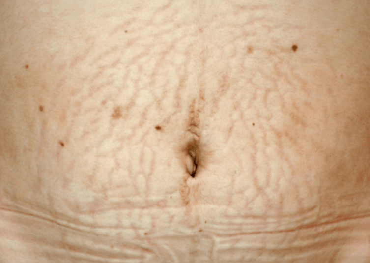 Fresh abdominal skin stretch marks before treatment