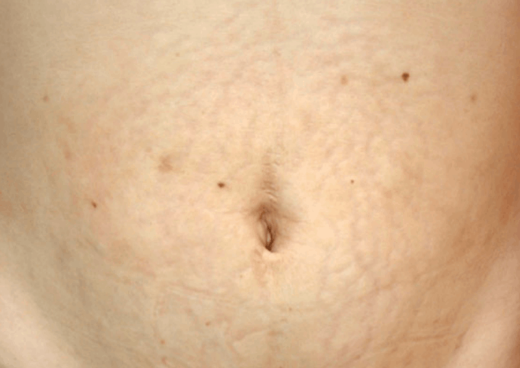 abdominal skin stretch marks after microneedling therapy