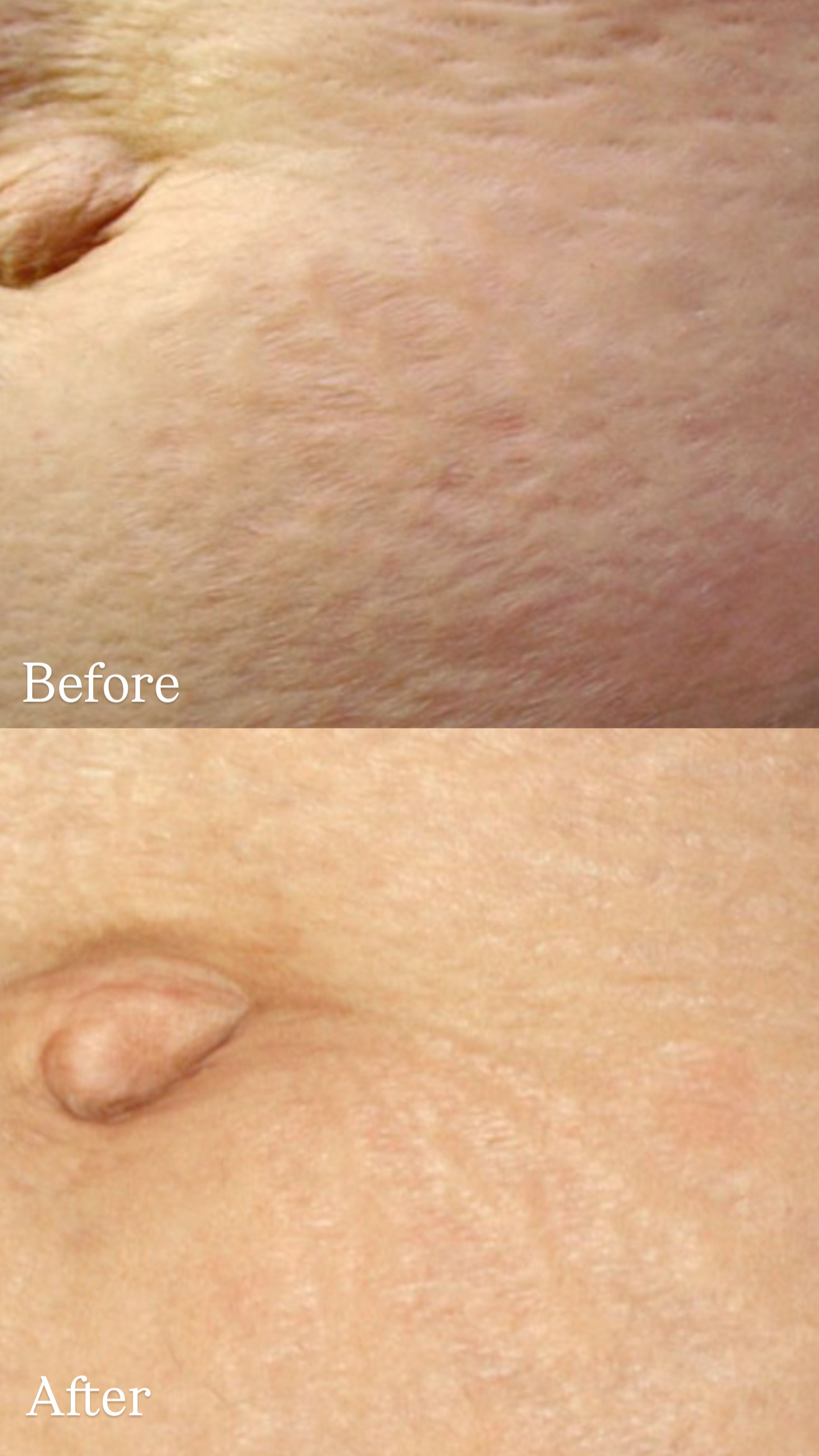 Abdominal Skin Stretch Marks before and after TCA Peel