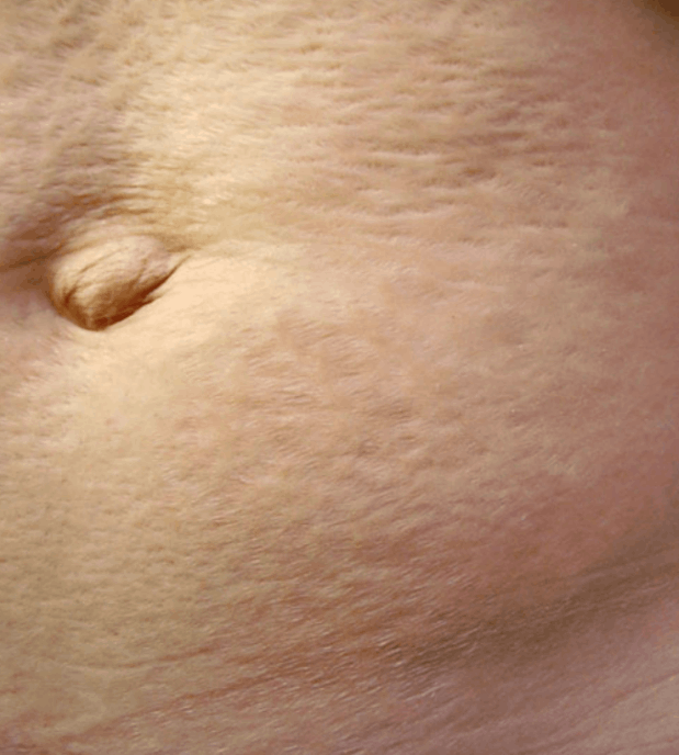 Abdominal skin stretch marks before TCA Peel