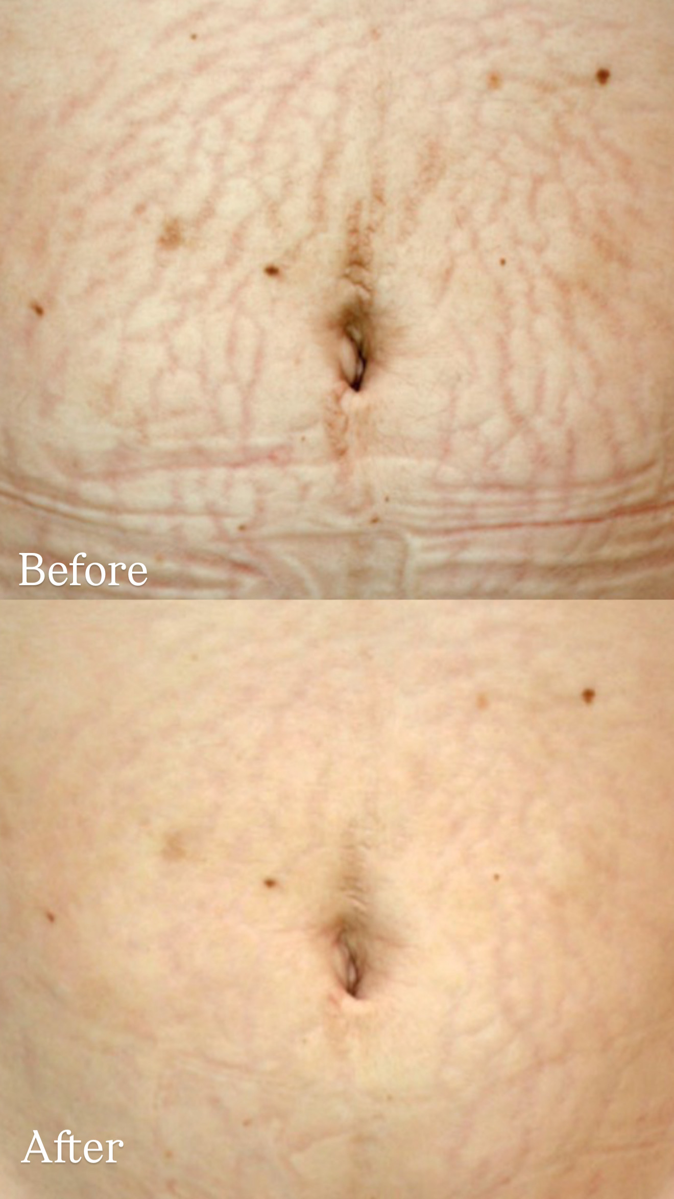 Abdominal Skin Stretch Marks after Microneedling Therapy