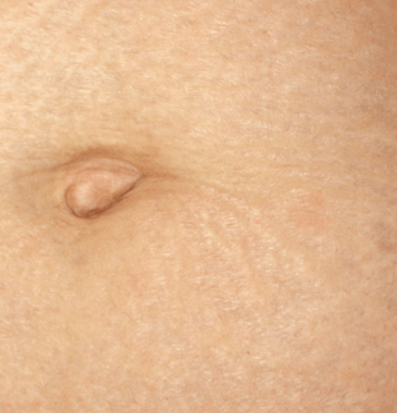 Abdominal skin stretch marks after TCA Peel